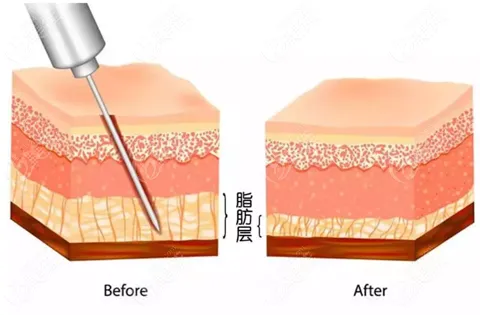 抽脂手術(shù)對(duì)身體有什么傷害？該不該禁止抽脂手術(shù)？